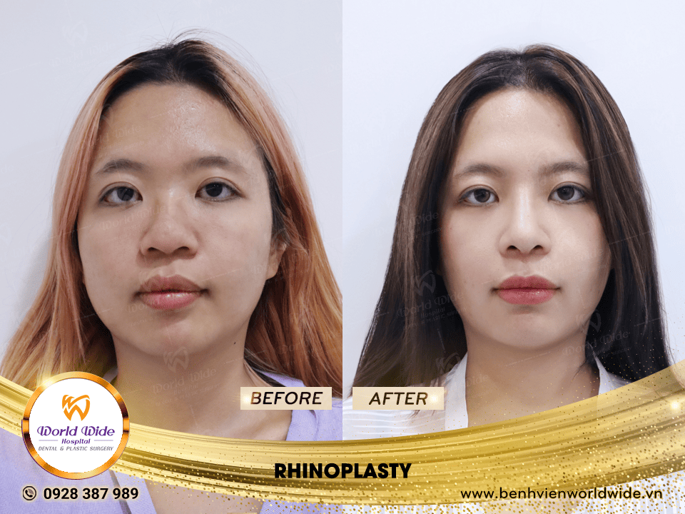 Self cartilage lifting RHINOPLASTY