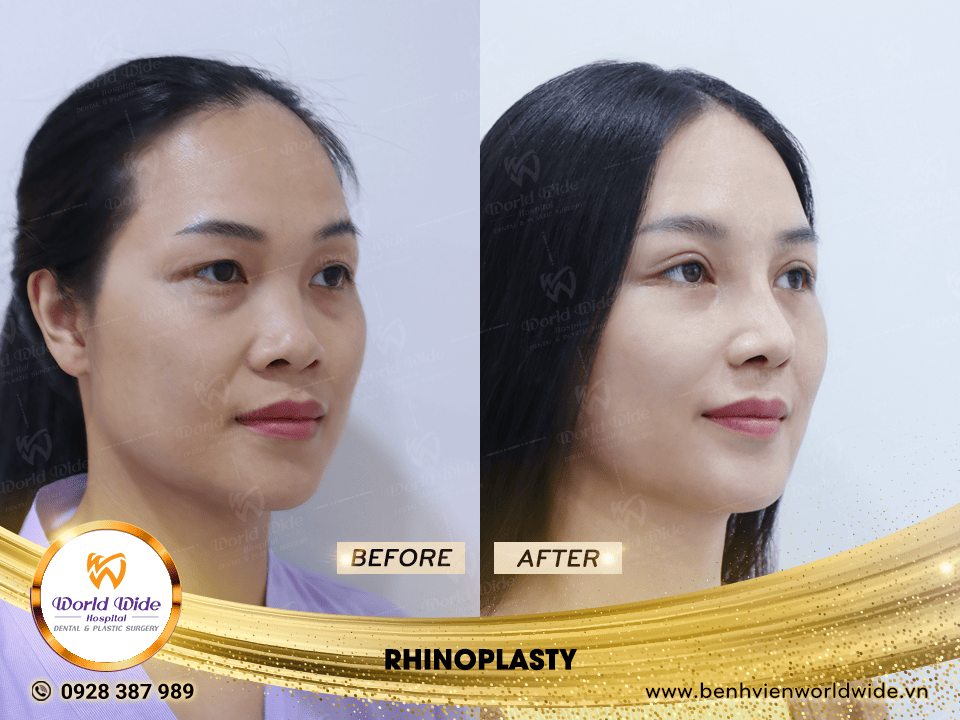 Self cartilage lifting RHINOPLASTY