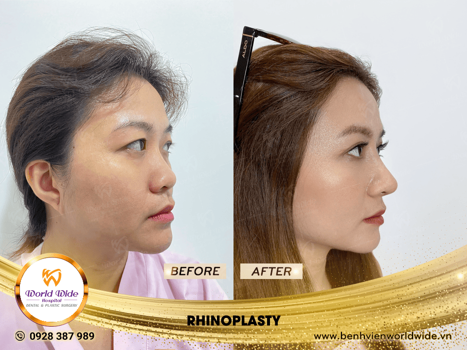 Self cartilage lifting RHINOPLASTY