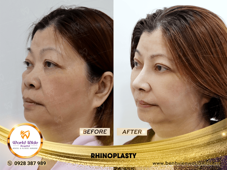 Self cartilage lifting RHINOPLASTY