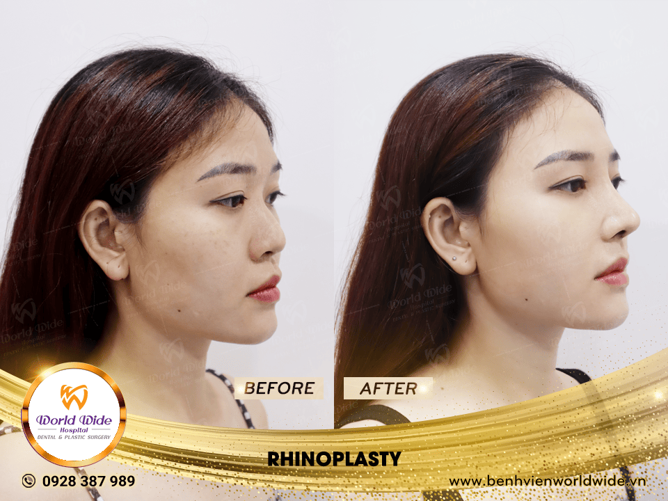 Self cartilage lifting RHINOPLASTY