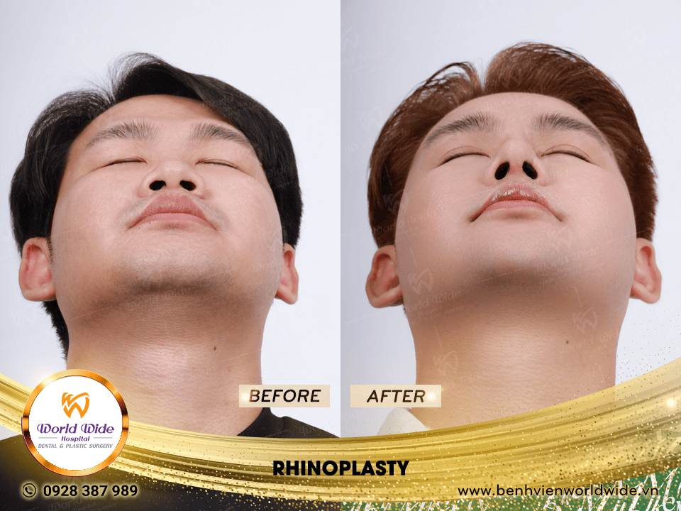 Self cartilage lifting RHINOPLASTY