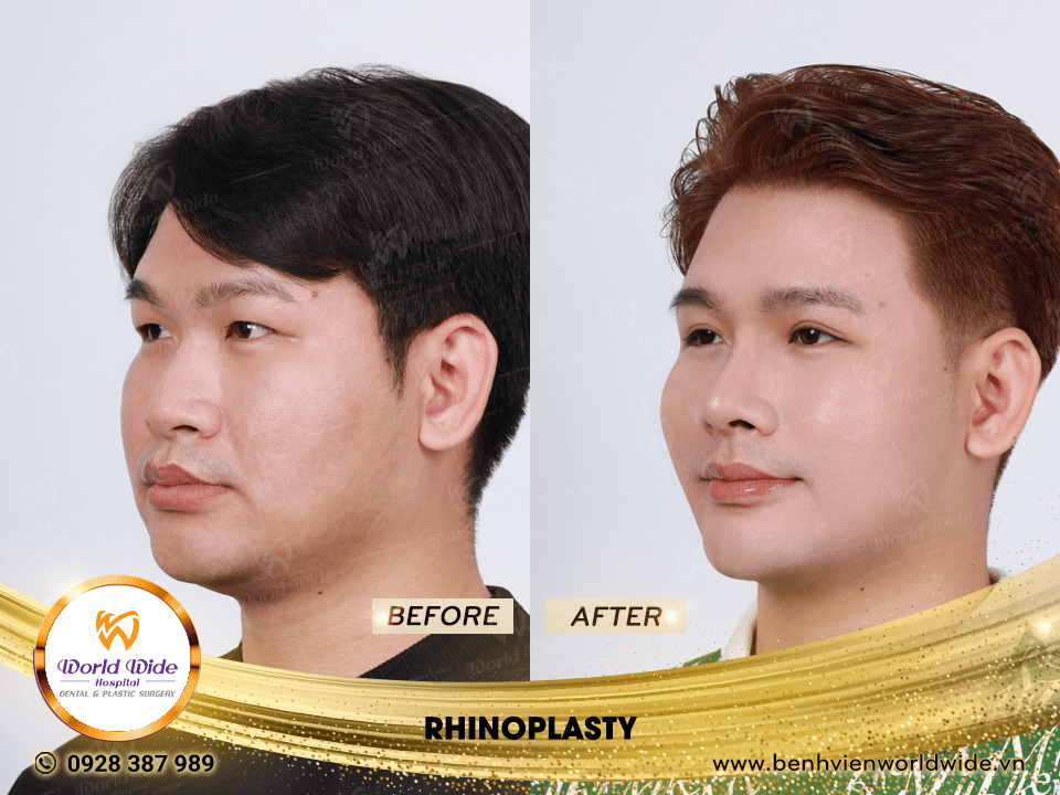 Self cartilage lifting RHINOPLASTY