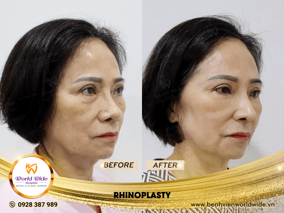 Self cartilage lifting RHINOPLASTY