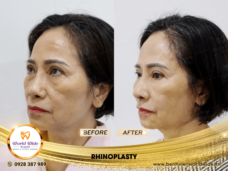 Self cartilage lifting RHINOPLASTY