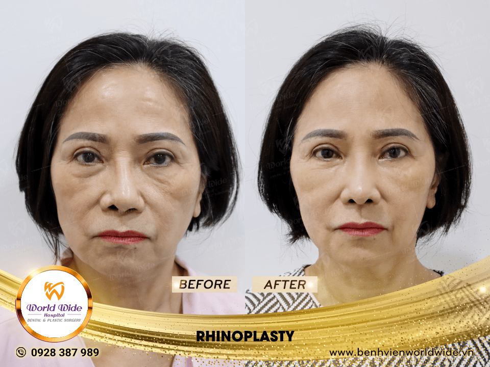 Self cartilage lifting RHINOPLASTY