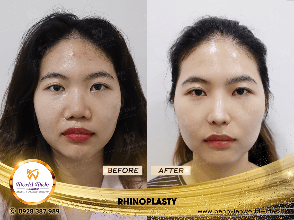 Self cartilage lifting RHINOPLASTY