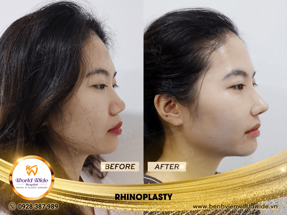 Self cartilage lifting RHINOPLASTY