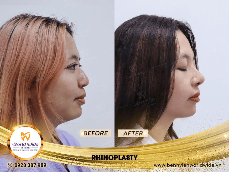 Self cartilage lifting RHINOPLASTY