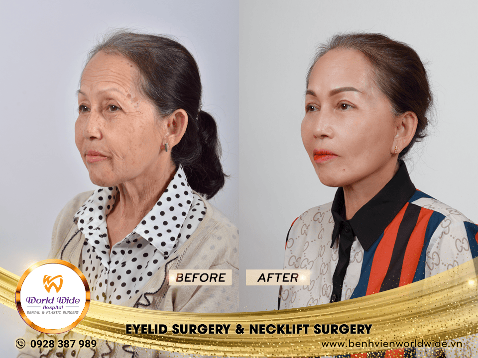 eyelid surgery & neckllift surgery