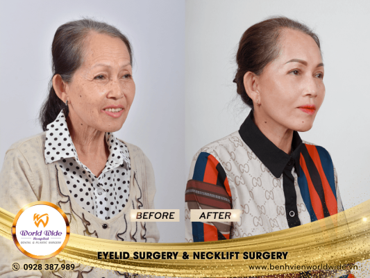 DIMPLEPLASTY eyelid surgery & neckllift surgery