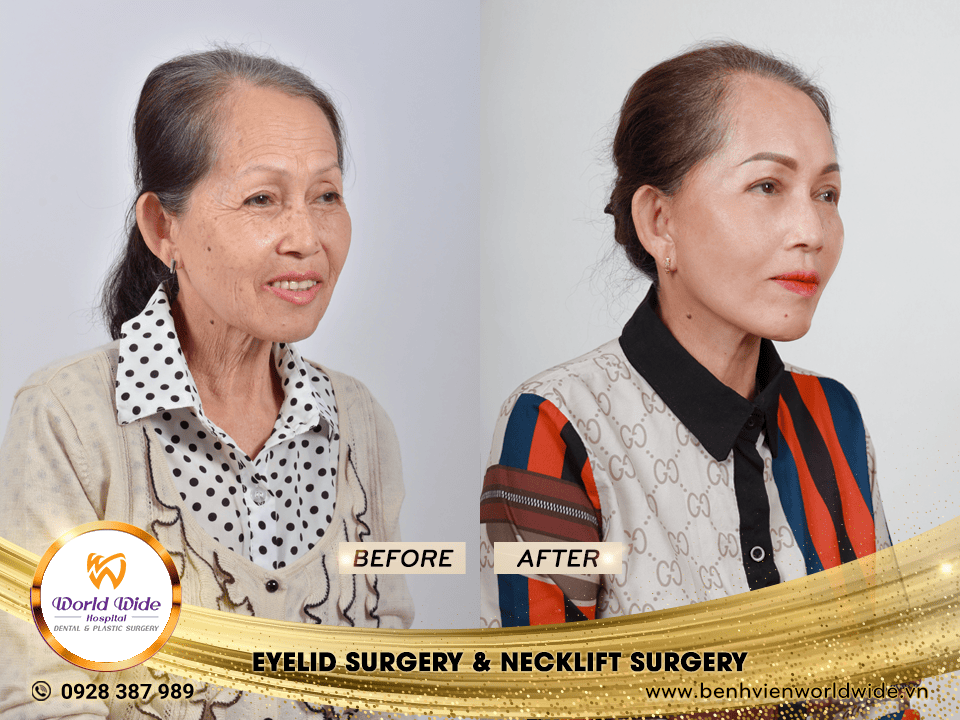 eyelid surgery & neckllift surgery