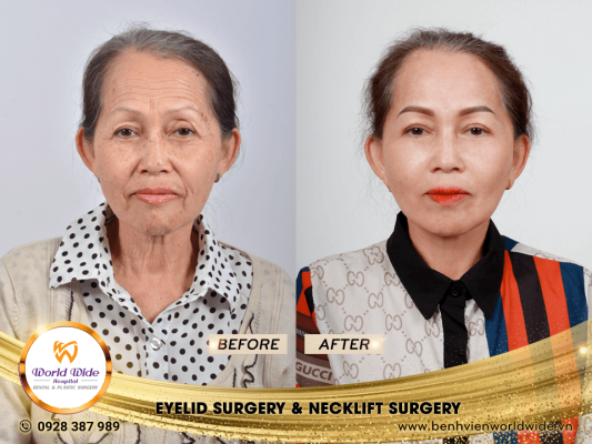 DIMPLEPLASTY eyelid surgery & neckllift surgery