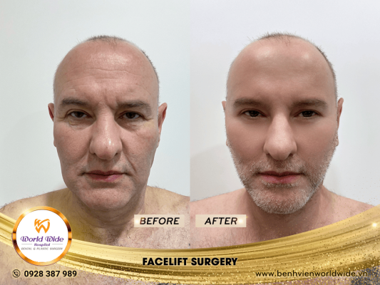 DIMPLEPLASTY facelift surgery