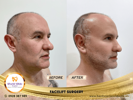 DIMPLEPLASTY facelift surgery