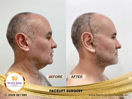 DIMPLEPLASTY facelift surgery