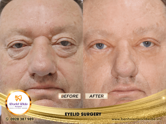 EYELID ELITE 5.0 cắt mí eyelid surgery 1