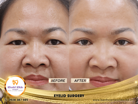 EYELID ELITE 5.0 cắt mí eyelid surgery 2