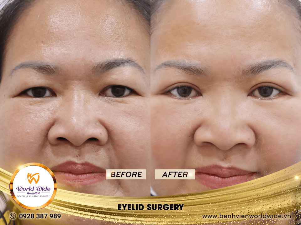 cắt mí eyelid surgery 2