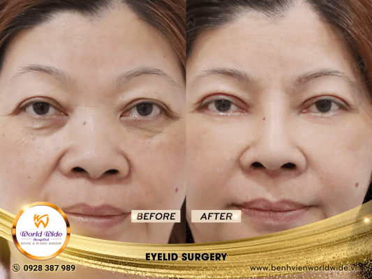 EYELID ELITE 5.0 cắt mí eyelid surgery 3