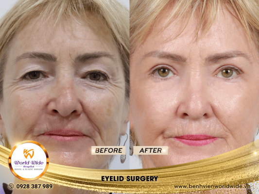EYELID ELITE 5.0 cắt mí eyelid surgery 4
