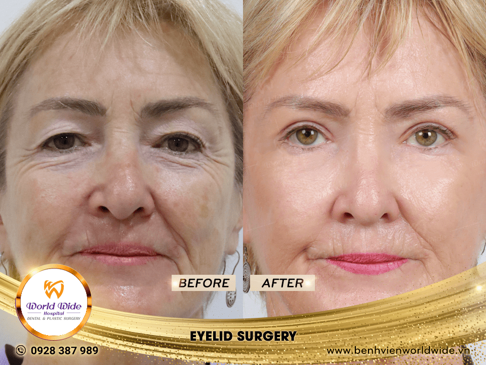 Gallery cắt mí eyelid surgery 4