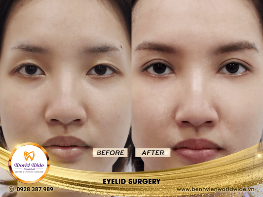 EYELID ELITE 5.0 cắt mí eyelid surgery 5