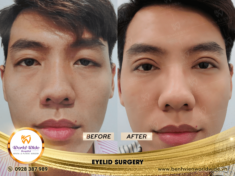 cắt mí eyelid surgery 6