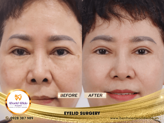 EYELID ELITE 5.0 cắt mí eyelid surgery 7