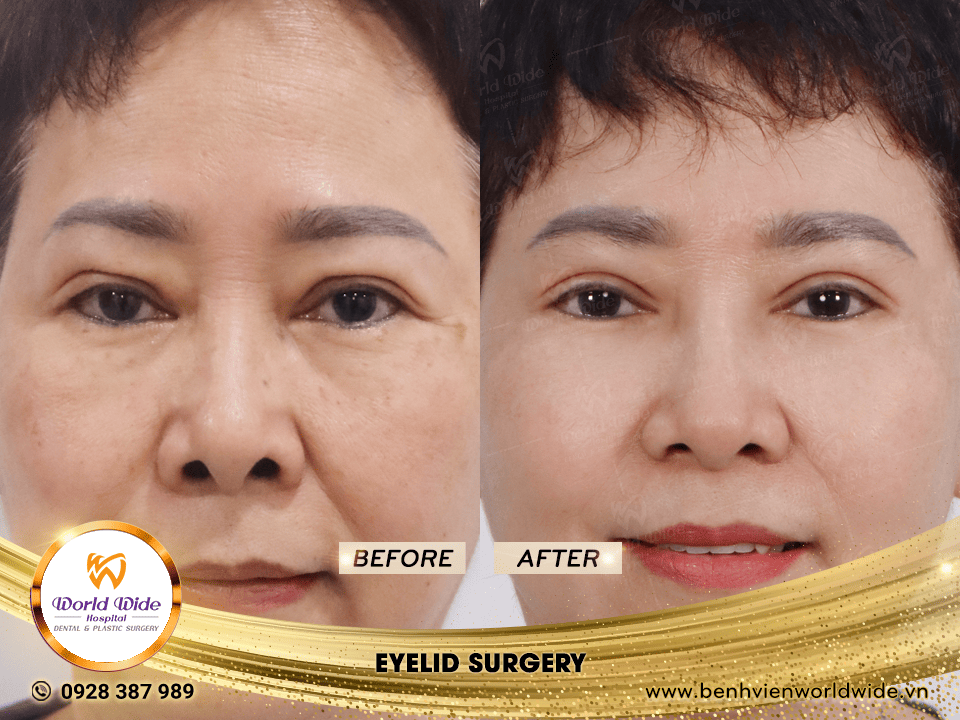 cắt mí eyelid surgery 7