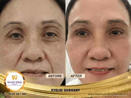 EYELID ELITE 5.0 cắt mí eyelid surgery 8