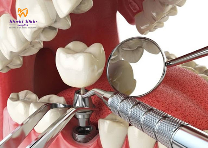 BAD BREATH implant dich vu