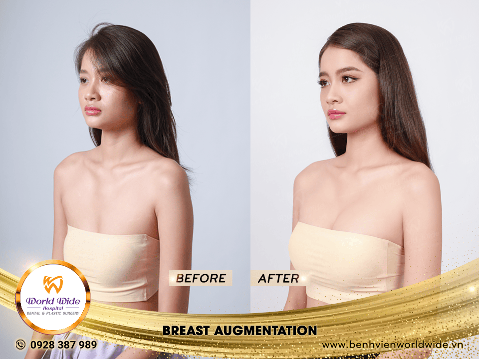 breast augmentation