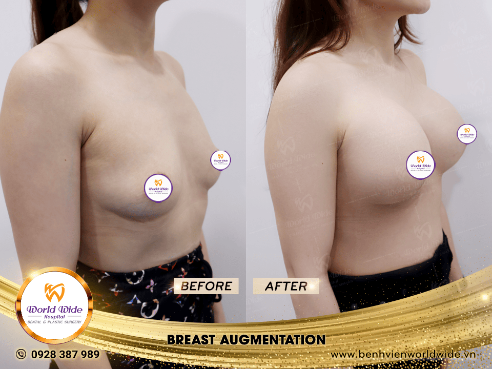 breast augmentation
