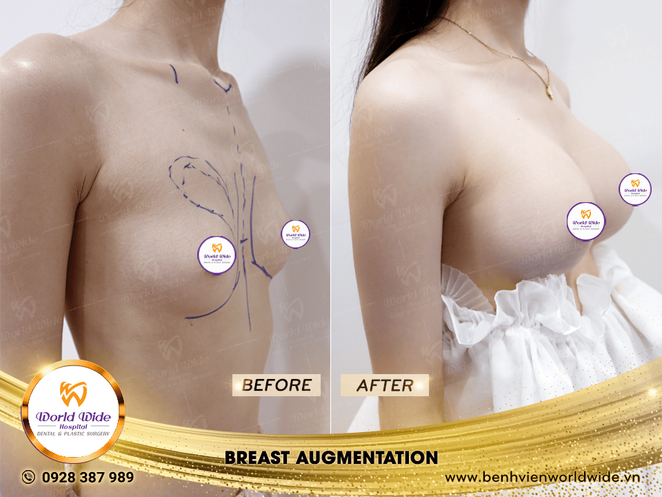 breast augmentation