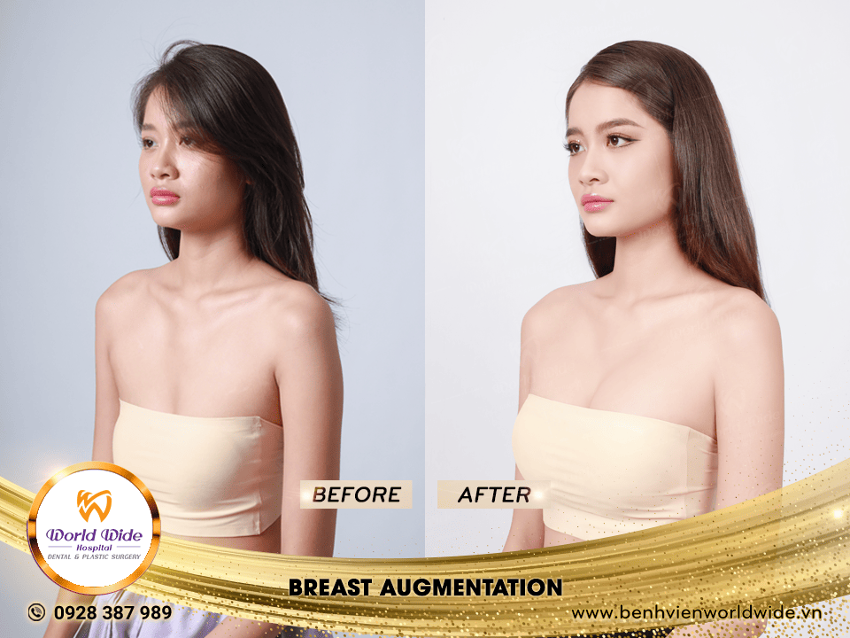 breast augmentation