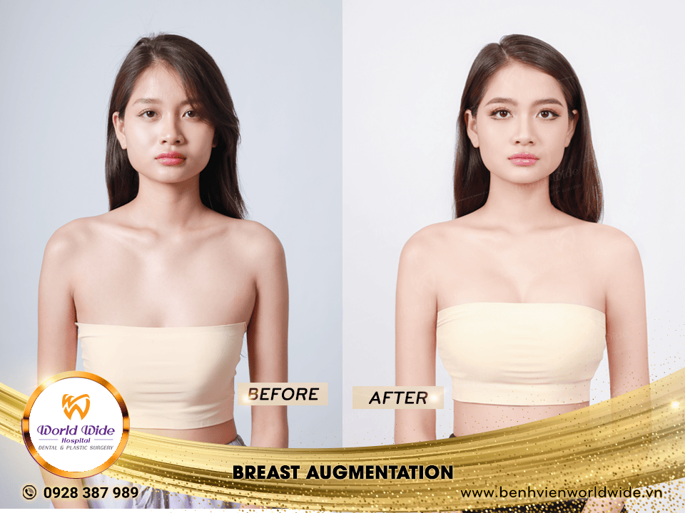 breast augmentation