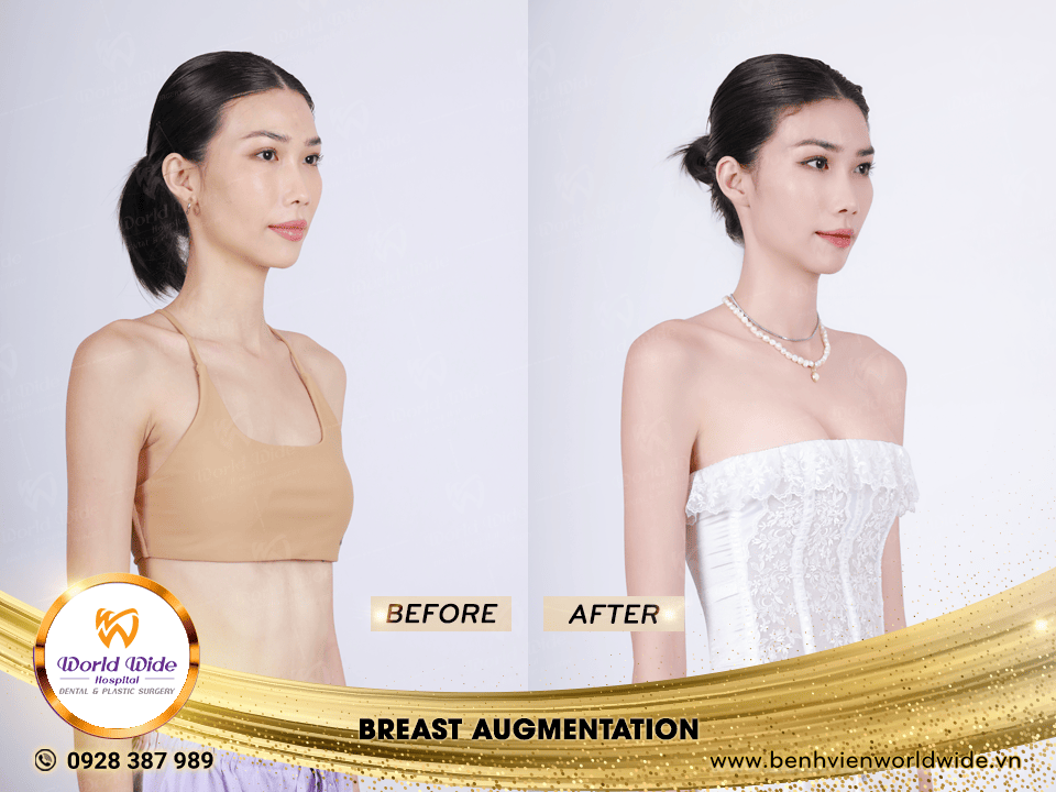 breast augmentation