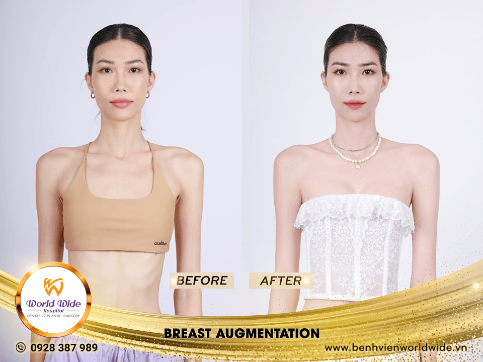 breast augmentation