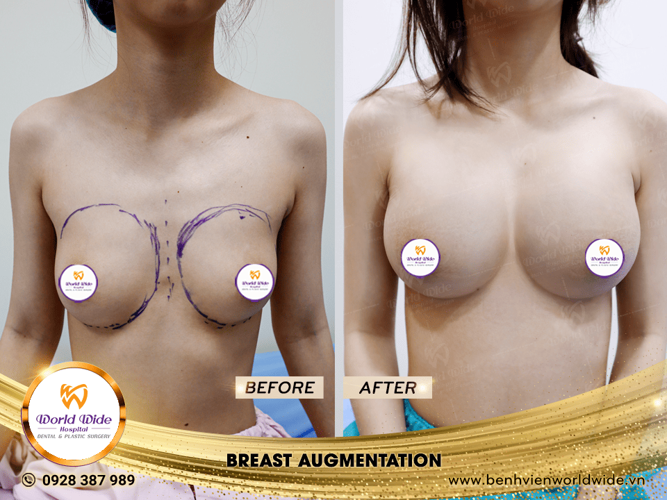 breast augmentation