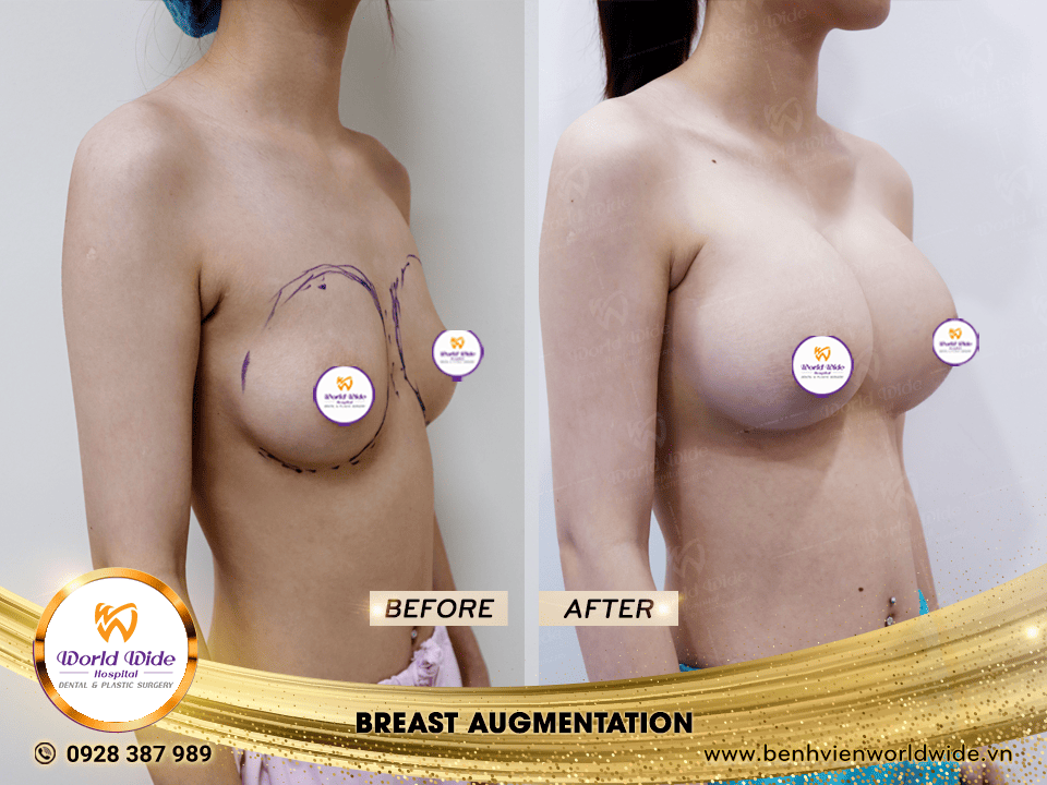 breast augmentation