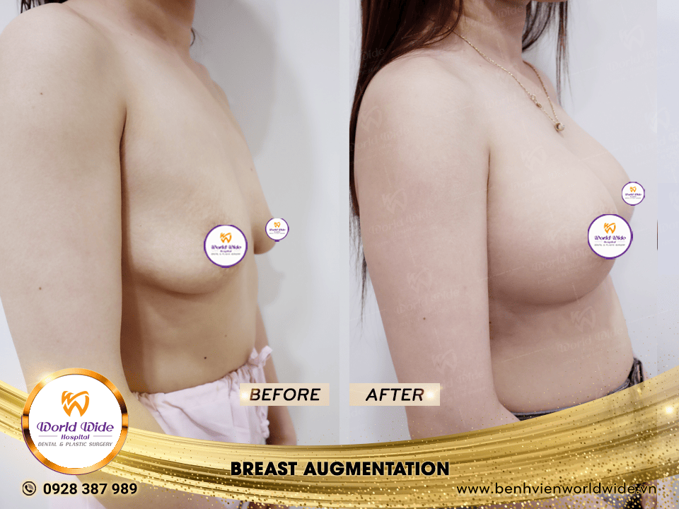 breast augmentation