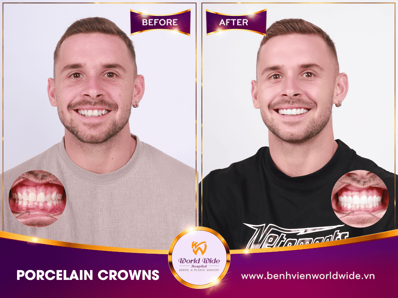 PORCELAIN CROWNS