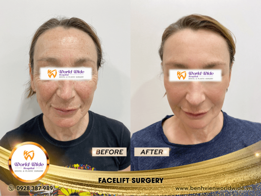 DIMPLEPLASTY facelift surgery