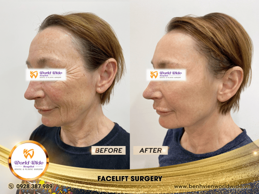 DIMPLEPLASTY facelift surgery