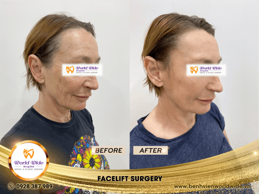 DIMPLEPLASTY facelift surgery