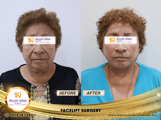 DIMPLEPLASTY facelift surgery