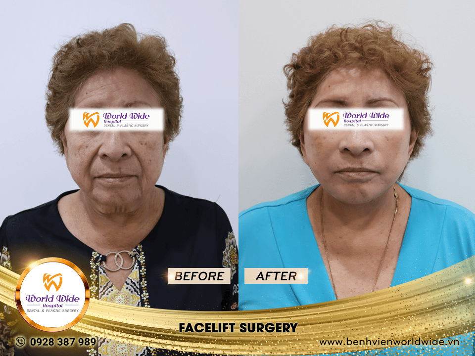 facelift surgery