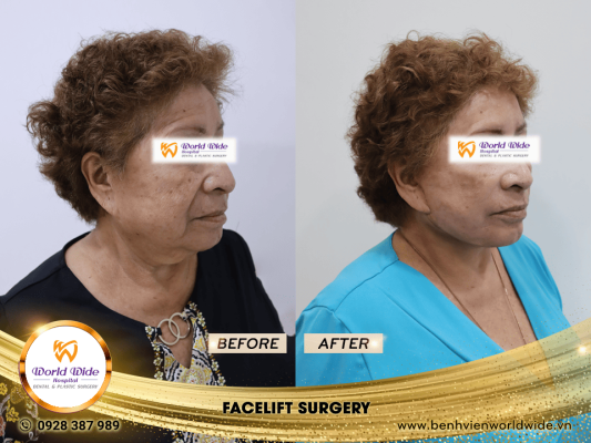 DIMPLEPLASTY facelift surgery
