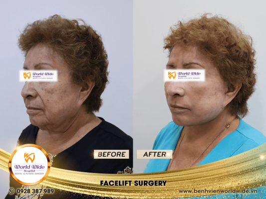 DIMPLEPLASTY facelift surgery